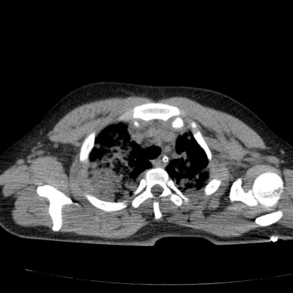 File:Acute aspiration pneumonitis (Radiopaedia 33605-34703 Axial non-contrast 26).jpg