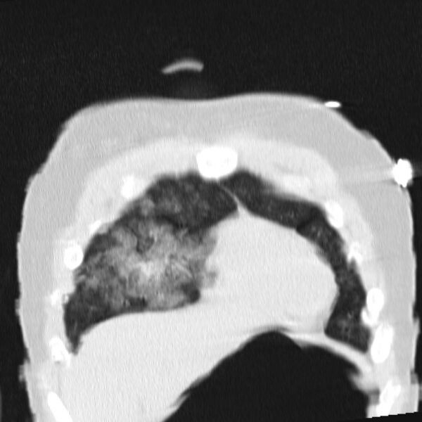 File:Acute aspiration pneumonitis (Radiopaedia 33605-34703 Coronal lung window 19).jpg