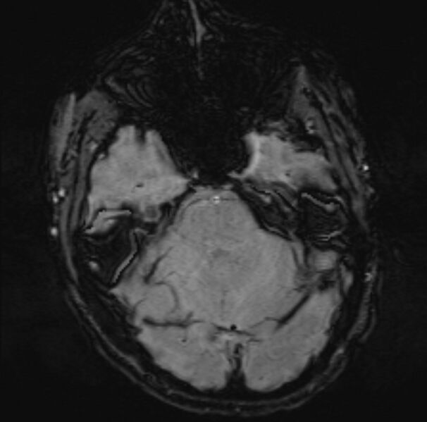 File:Acute ischemic stroke - posterior circulation territory (Radiopaedia 77670-89880 Axial SWI 18).jpg