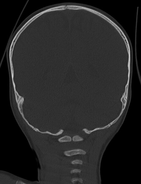 File:Acute mastoiditis (Radiopaedia 82678-96881 Coronal bone window 57).jpg
