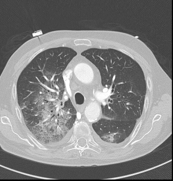 File:Acute myocardial infarction (Radiopaedia 23413-23481 lung window 12).jpg