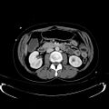 Acute myocardial infarction in CT (Radiopaedia 39947-42415 Axial C+ portal venous phase 57).jpg