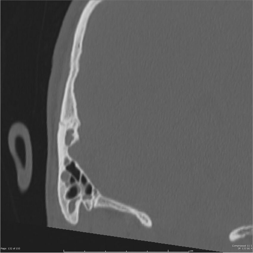 Acute otomastoiditis (Radiopaedia 28276-28512 Coronal PTB bone window reformat 63).jpg