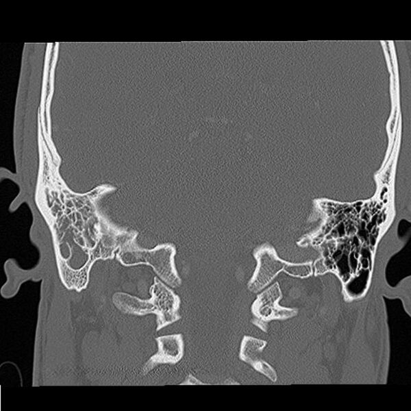 File:Acute otomastoiditis (Radiopaedia 28329-28575 Coronal bone window 5).jpg