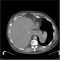 Acute pancreatitis (Radiopaedia 19135-19116 Axial non-contrast 4).jpg