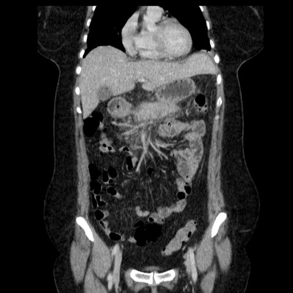 File:Acute pancreatitis - Balthazar C (Radiopaedia 26569-26714 Coronal C+ portal venous phase 26).jpg