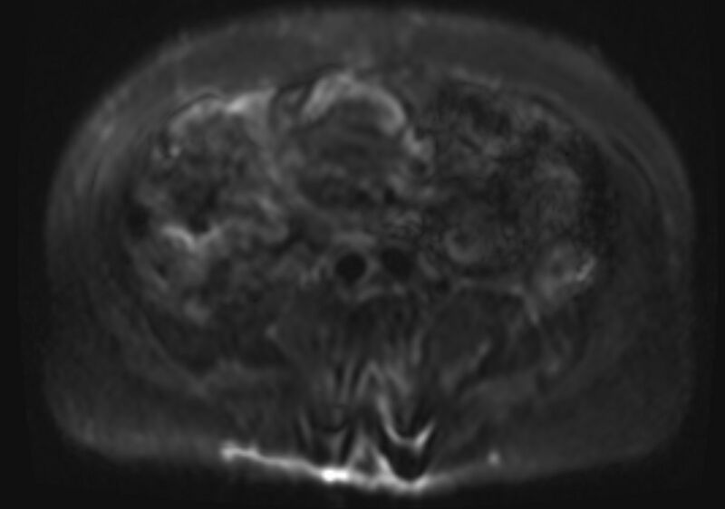 File:Acute portal vein thrombosis (Radiopaedia 73198-83925 Axial DWI 27).jpg