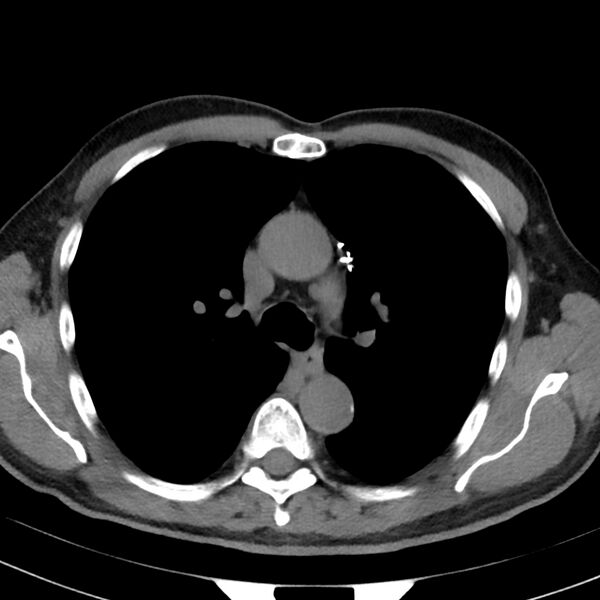 File:Acute pulmonary embolism (Radiopaedia 81677-95570 Axial non-contrast 7).jpg
