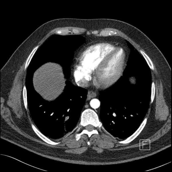 File:Acute pulmonary embolism with pulmonary infarct (Radiopaedia 73062-83768 Axial C+ CTPA 56).jpg