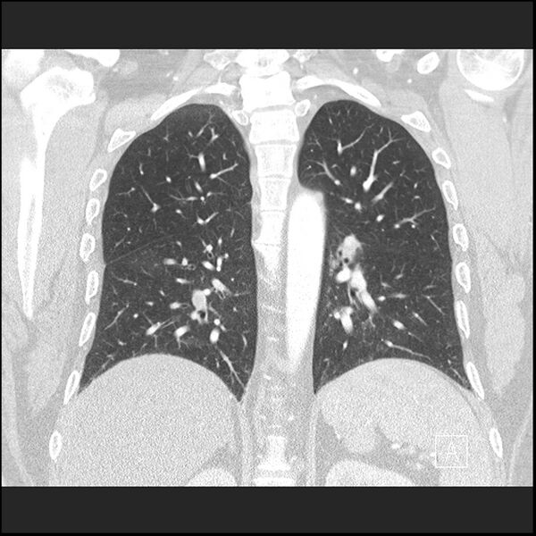 File:Acute pulmonary embolism with pulmonary infarct (Radiopaedia 73062-83768 Coronal lung window 50).jpg