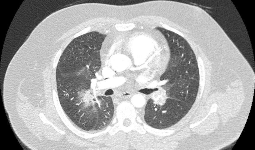 Acute pulmonary embolism with pulmonary infarcts (Radiopaedia 77688-89908 Axial lung window 52).jpg