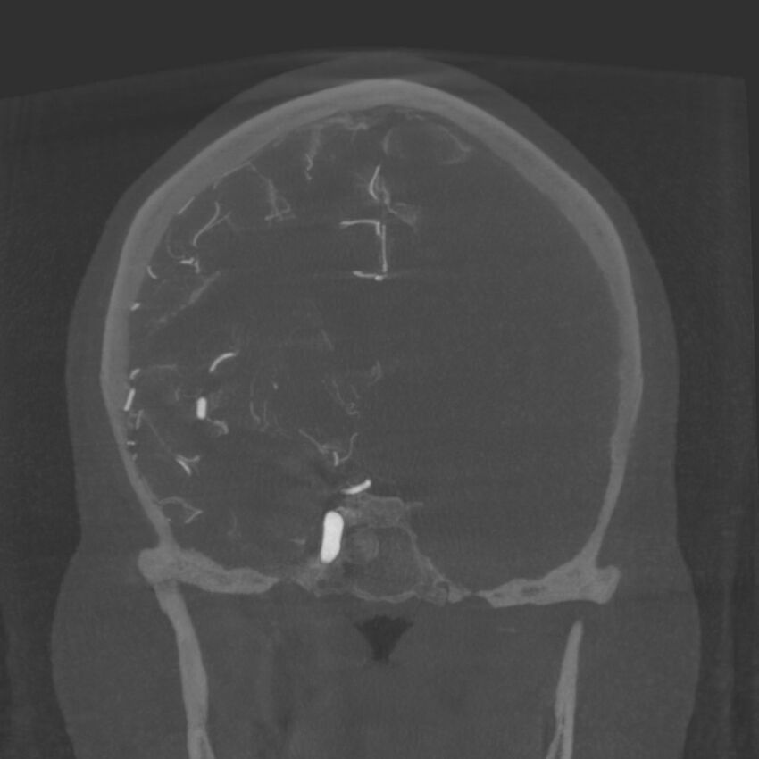 Acute subarachnoid hemorrhage and accessory anterior cerebral artery (Radiopaedia 69231-79010 Coronal arterial - MIP 49).jpg
