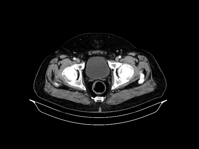File:Adenocarcinoma of pancreas with hepatic metastasis (Radiopaedia 64332-73122 Axial C+ portal venous phase 96).jpg