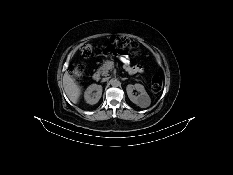 File:Adenocarcinoma of pancreas with hepatic metastasis (Radiopaedia 64332-73122 Axial non-contrast 38).jpg