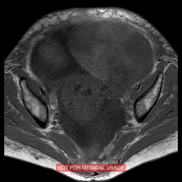 File:Adenocarcinoma of the cervix (Radiopaedia 28373-28615 Axial T1 15).jpg