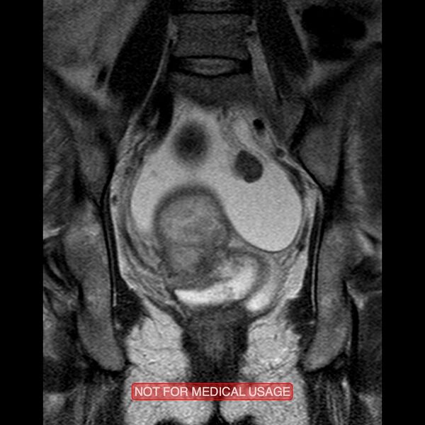 File:Adenocarcinoma of the cervix (Radiopaedia 28373-28615 Coronal T2 13).jpg