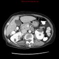 Adenocarcinoma of the colon (Radiopaedia 8191-9039 Axial liver window 29).jpg
