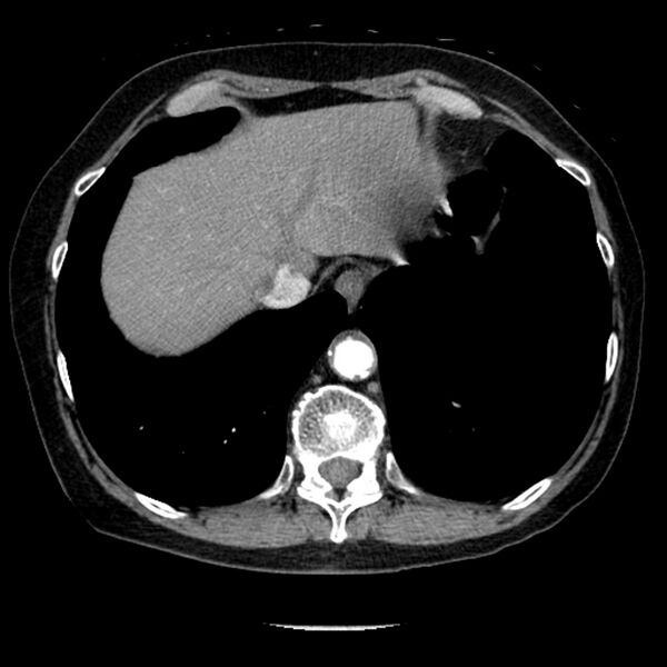 File:Adenocarcinoma of the lung (Radiopaedia 41015-43755 Axial C+ portal venous phase 102).jpg