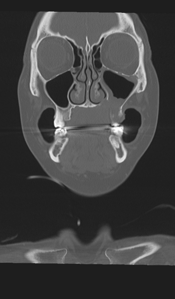File:Adenoid cystic tumor of palate (Radiopaedia 46980-51518 Coronal bone window 20).png