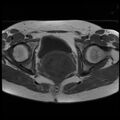 Adenoma malignum of the cervix (Radiopaedia 24460-24765 T1 14).jpg