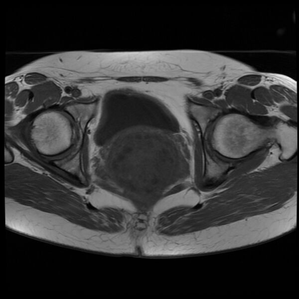 File:Adenoma malignum of the cervix (Radiopaedia 24460-24765 T1 14).jpg