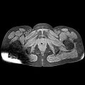 Adenomyoma of the uterus (huge) (Radiopaedia 9870-10438 Axial T1 fat sat 5).jpg