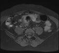 Adenomyosis - ovarian endometriomas (Radiopaedia 67031-76350 Axial T1 fat sat 4).jpg