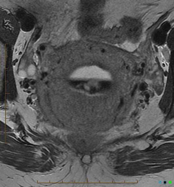 File:Adenomyosis uterus with hematometra (Radiopaedia 45779-50011 Axial T2 18).jpg