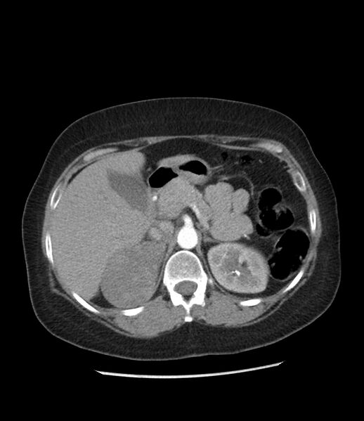 File:Adrenal cortical carcinoma with IVC invasion and thrombosis (Radiopaedia 34307-35597 Axial C+ arterial phase 27).jpg