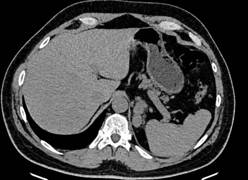 File:Adrenal metastases (Radiopaedia 73082-83791 Axial non-contrast 35).jpg