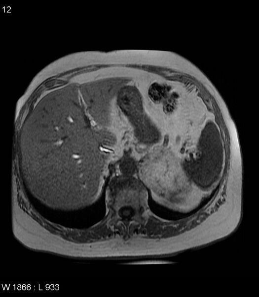 File:Adrenal myelolipoma (Radiopaedia 6765-7961 Axial T1 in-phase 12).jpg