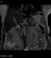 Adrenal myelolipoma (Radiopaedia 6765-7961 Coronal T2 10).jpg