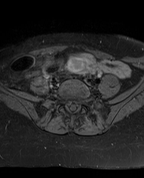 File:Adult granulosa cell tumor of the ovary (Radiopaedia 71581-81950 Axial T1 C+ fat sat 5).jpg