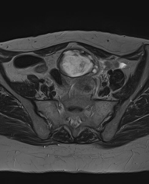File:Adult granulosa cell tumor of the ovary (Radiopaedia 71581-81950 Axial T2 9).jpg