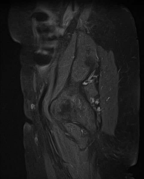 File:Adult granulosa cell tumor of the ovary (Radiopaedia 71581-81950 Sagittal T1 C+ fat sat 2).jpg