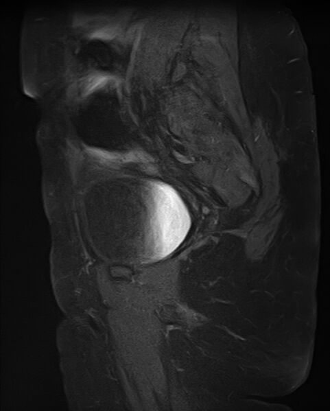 File:Adult granulosa cell tumor of the ovary (Radiopaedia 71581-81950 Sagittal T1 C+ fat sat 7).jpg