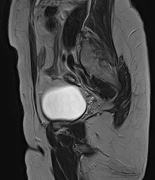 File:Adult granulosa cell tumor of the ovary (Radiopaedia 71581-81950 Sagittal T2 6).jpg