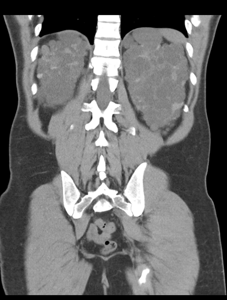 File:Adult polycystic kidney disease (Radiopaedia 47866-52626 Coronal non-contrast 40).png