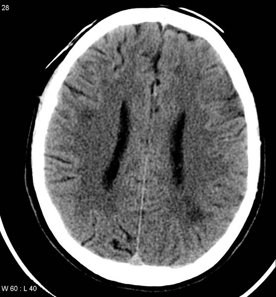 File:Aicardi syndrome (Radiopaedia 5353-7116 Axial non-contrast 25).jpg