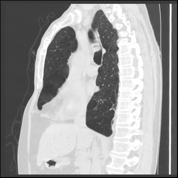 File:Alpha-1-antitrypsin deficiency (Radiopaedia 40993-43722 Sagittal lung window 147).jpg