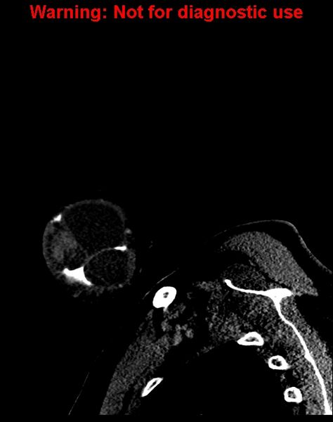 File:Ameloblastoma (Radiopaedia 33126-34164 F 7).jpg