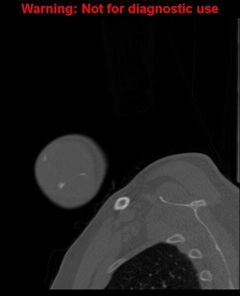 File:Ameloblastoma (Radiopaedia 33126-34164 Sagittal bone window 9).jpg