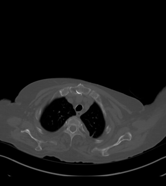 File:Amiodarone deposition in the liver (Radiopaedia 77587-89780 Axial bone window 15).jpg