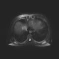 Ampullary tumor (Radiopaedia 27294-27479 T2 SPAIR 19).jpg