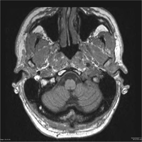 File:Anaplastic meningioma with recurrence (Radiopaedia 34452-35788 Axial T1 8).jpg