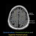 Anatomy- sulci of the brain (Radiopaedia 33834-34995 Central sulcus 8).jpg