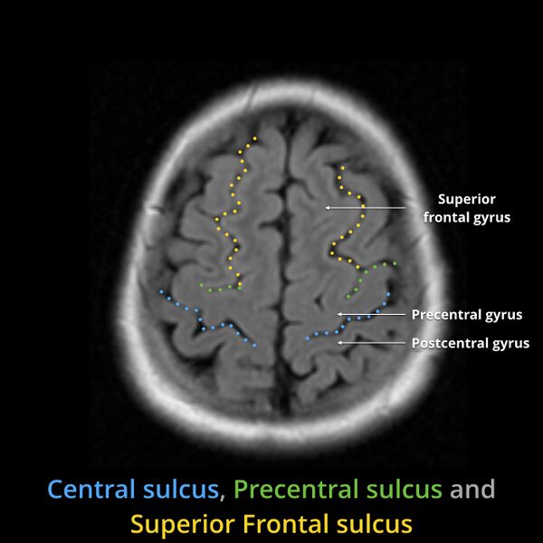File:Anatomy- sulci of the brain (Radiopaedia 33834-34995 Central sulcus 8).jpg