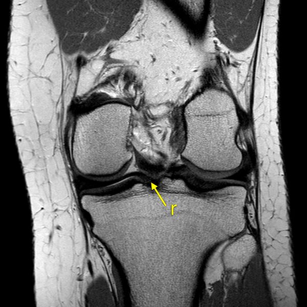 File:Anatomy Quiz (MRI knee) (Radiopaedia 43478-46874 A 20).jpeg