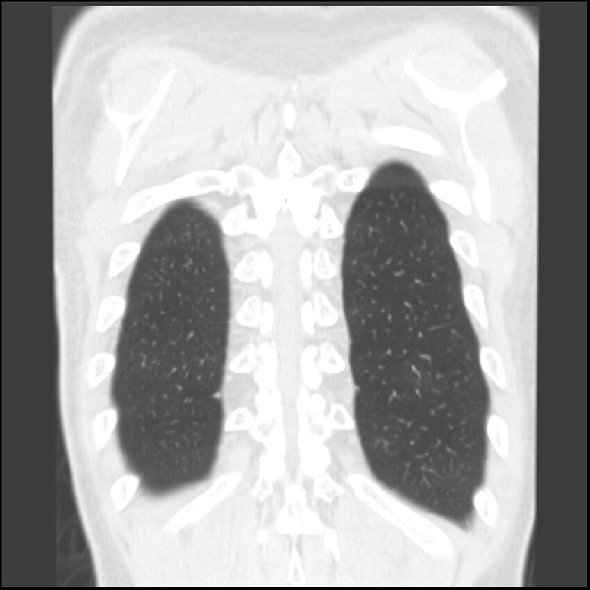Angioinvasive aspergillosis (Radiopaedia 43957-47466 Coronal lung window 9).jpg