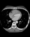 Anomalous coronary arteries (Radiopaedia 83979-99206 A 172).jpg